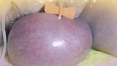 Perverted guy injects saline in his scrotum to make it larger