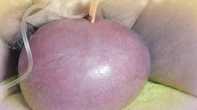 Perverted guy injects saline in his scrotum to make it larger