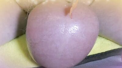 Perverted guy injects saline in his scrotum to make it larger