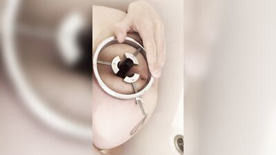 anal retractor and prolapse in close-up and my prolapse