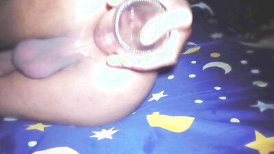 fisting anal gaping and prolapse